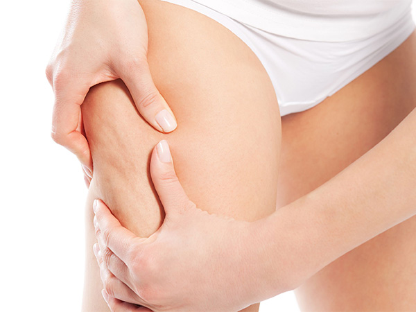 Cellulite Là Gì? Làm Sao Để Ngăn Cellulite làm xấu làn da