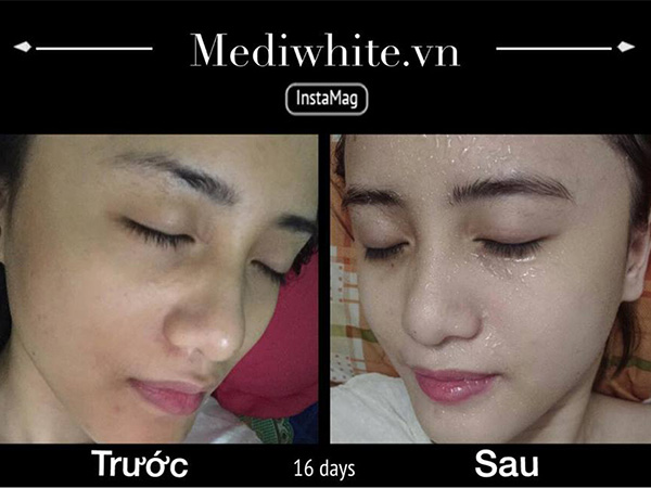 Da trắng mịn chỉ trong 20 ngày bằng liệu trình Medi White